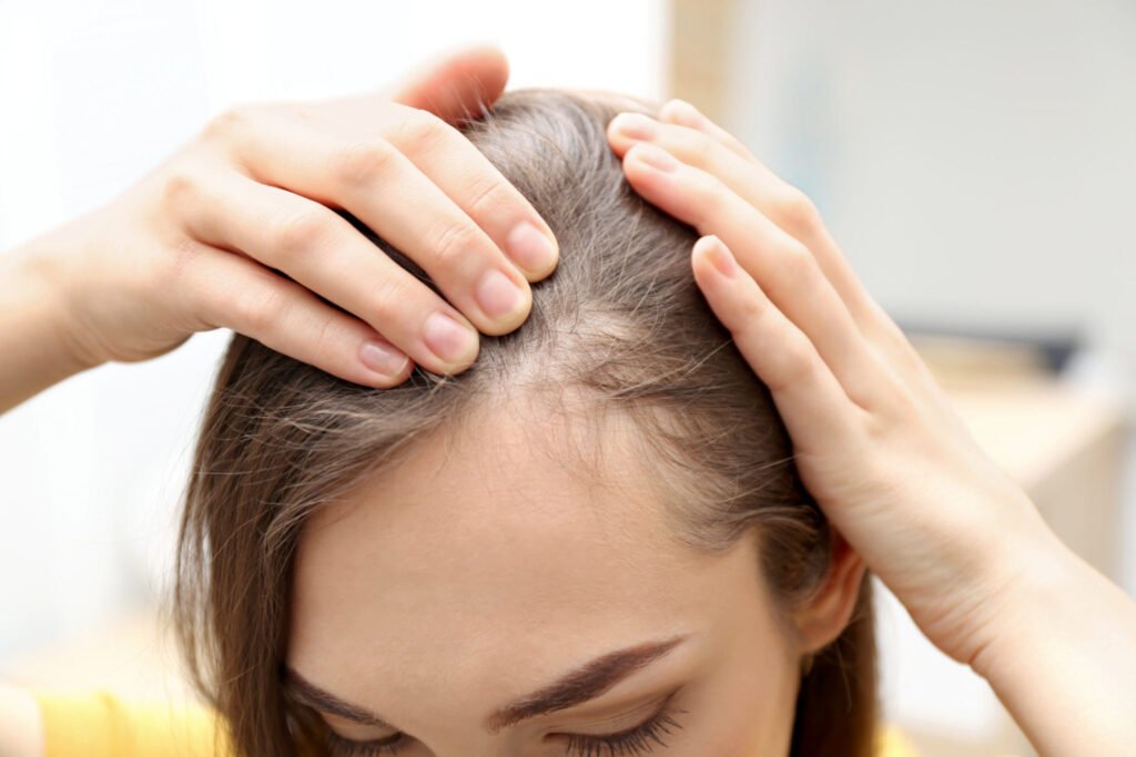 Alopecia Androg Nica Femenina Causas S Ntomas Y Tratamientos
