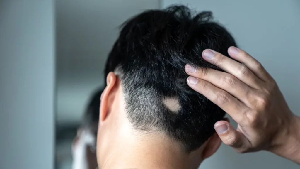 persona joven con alopecia areata