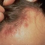 alopecia seborreica