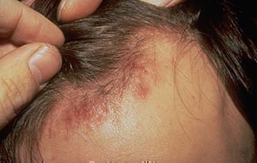 una persona con un claro comienzo de alopecia seborreica