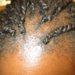 alopecia-traccional