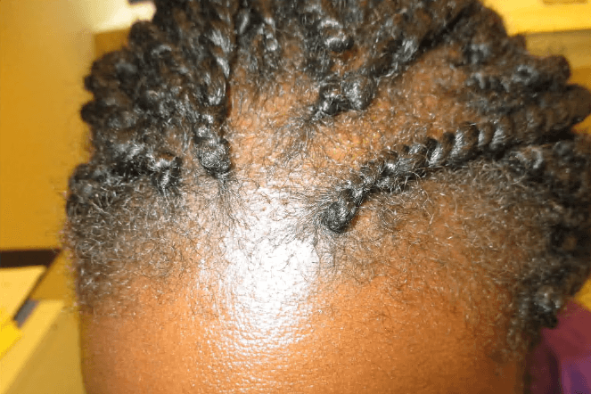 Una mujer con alopecia por tracción