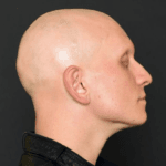 alopecia-universal