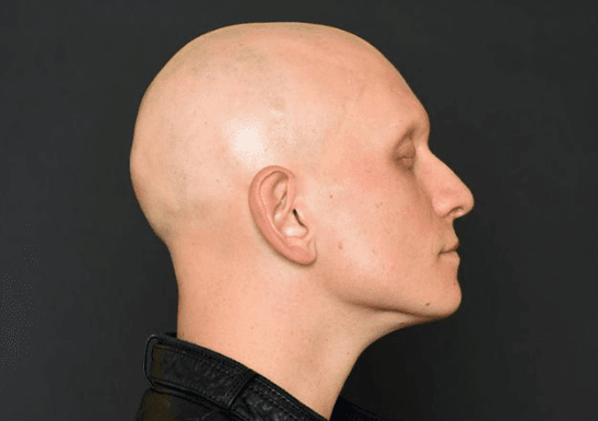 un señor con una clara alopecia universal