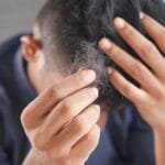 Un hombre con un principio de Alopecia nerviosa