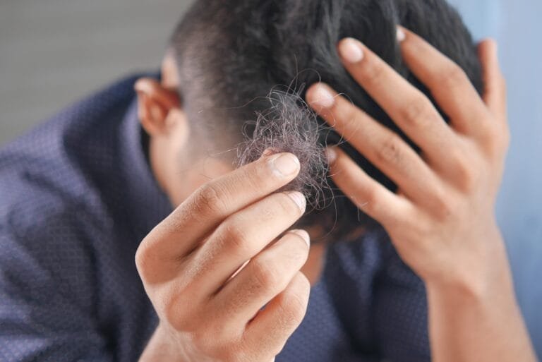 Un hombre con un principio de Alopecia nerviosa