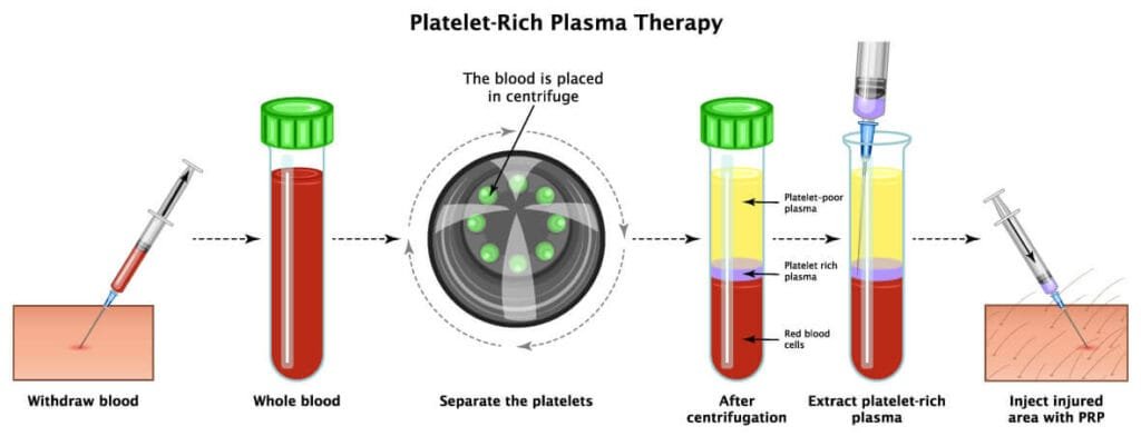Proceso completo del plasma rico en plaquetas, desde que sacan la muestra hasta que lo aplican en el cuero cabelludo.