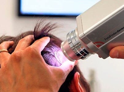 Hombre haciéndose un estudio tricograma capilar para detectar el origen de su alopecia.