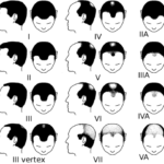 504px-Partial_Norwood_scale_for_male_pattern_baldness