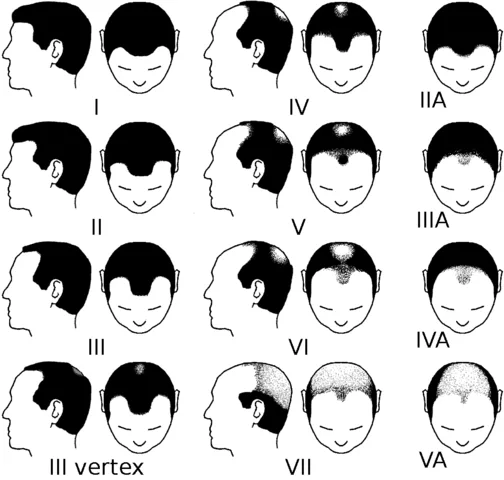 504px-Partial_Norwood_scale_for_male_pattern_baldness