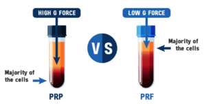 PRP vs PRF